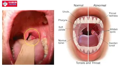What is tonsil cancer?