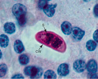 Hình 2: Mô nang của Isospora Ohioensis trong hạch bạch huyết mạc treo ruột của một con chuột thí nghiệm bị nhiễm. Các thoi trùng (S) được bao quanh bởi một bức tường u nang (CW).