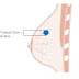 Breast Cancer स्तन कैंसर