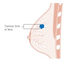 Breast Cancer स्तन कैंसर