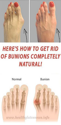 Why do doctors keep this simple recipe away from the public? Here’s how to get rid of bunions completely natural!