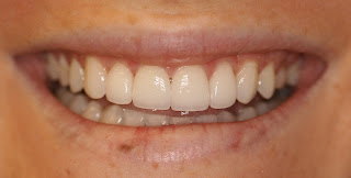 Boulder dentistry patient after a restorative dentistry by Dr. Adler.