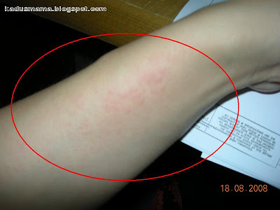 baby heat rash pictures. heat rash on aby. heat rash