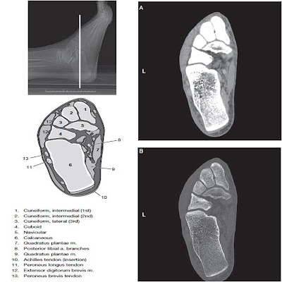 foot ct scan