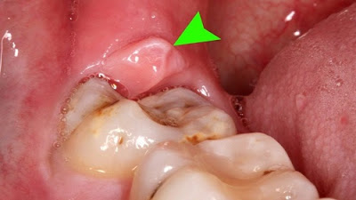 Sưng nướu răng không đau là bệnh gì?