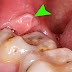 Sưng nướu răng không đau phải làm sao?