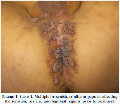 penyakit-kelamin-seks-bebas-virus-human-papilloma-vph-condylomes