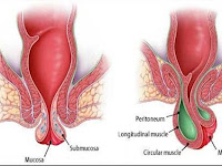 Mengatasi Wasir Atau Ambeien Dengan Cepat