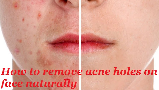 How to remove acne holes on face naturally