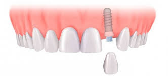 Cấy ghép implant không sưng đau