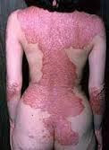 Eczema disease in the body.