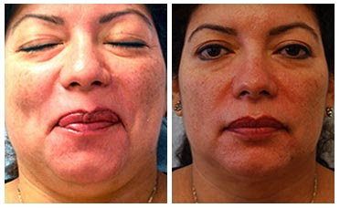 Mesotherapy Before After