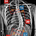 脊椎側彎矯正案例12 - 治療8次/胸椎側彎 37度→30度