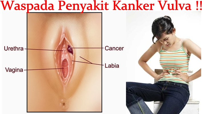 Obat Tradisional Kanker Vulva