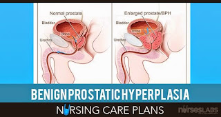 Bph nursing care plan - Nursing Care Plan Examples