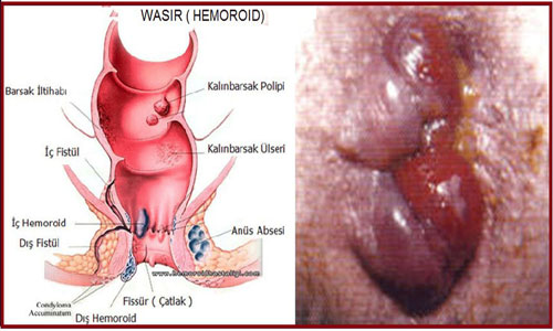 cara menyembuhkan ambeien luar secara alami,  penanganan ambeien luar,  foto ambeien luar,  cara Mengecilkan ambeien luar, 