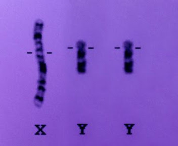 Anomalies du nombre des chromosomes sexuels