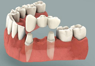 Ưu điểm phương pháp cầu răng sứ