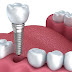 Thời gian cấy ghép răng implant bao lâu?