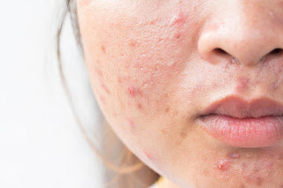 como combatir el acne, como combatir el acne de la cara