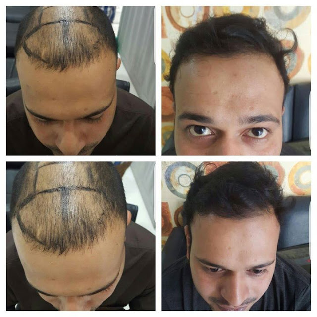 Hair Transplant Clinic in Mumbai