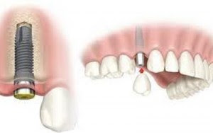  Hình thức làm răng giả thẩm mỹ nhất hiện nay 