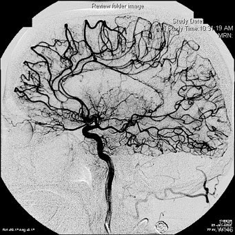 Megan's CT/MRI Pathology: Moyamoya Disease