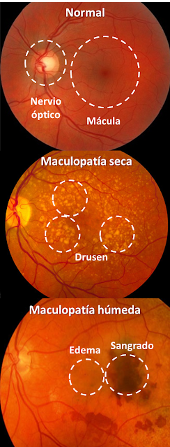 Maculopatía seca y húmeda