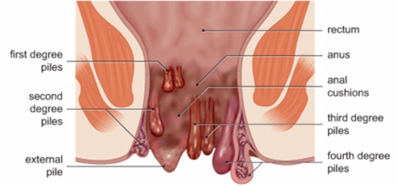 Benjolan Di Anus Setelah Bab