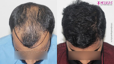 hair transplant in India