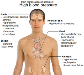 Symptoms of high blood pressure