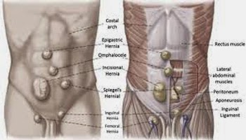 celana dalam hernia, celana hernia, celana untuk hernia, jual celana hernia, obat hernia, turun berok