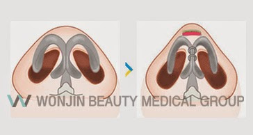 짱이뻐! - Korean Rhinoplasty - Nose Tip Correction