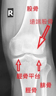 骨科李宜軒醫師 脛骨平台骨折tibia Plateau Fracture 脛骨近端骨折proximal Tibia Fracture