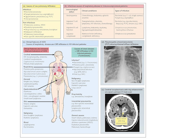 The Immunocompromised Host, Steroid therapy, Supportive therapy, Non-Hodgkin’s lymphoma