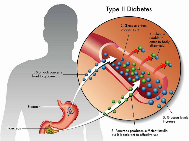 Diabetes Melitus Tipe 2 - Pengertian, Manifestasi Klinis, Diagnosis, Tatalaksana