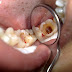 Cách khắc phục răng sâu bị vỡ lớn bằng bọc răng sứ