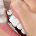 Răng cửa bị khấp khểnh bọc răng sứ bao lâu?