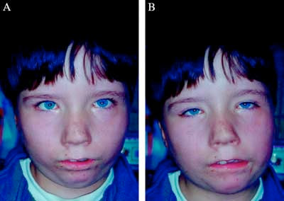 Möbius Syndrome<br />