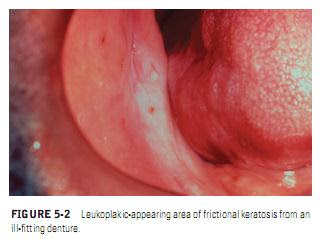 Frictional (Traumatic) Keratosis CLINICAL FEATURES