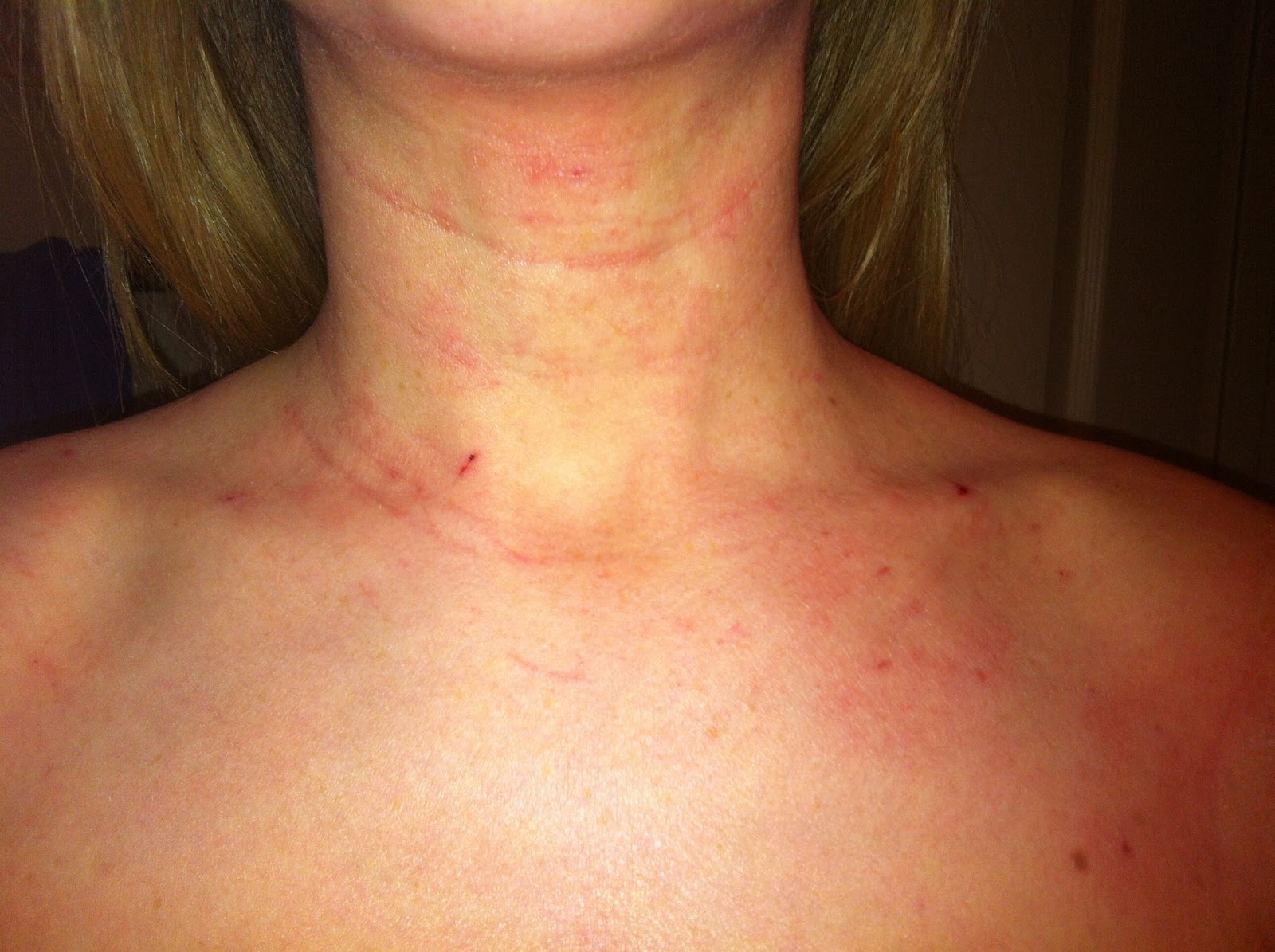 Red Bumps On Neck Neck and chest look great