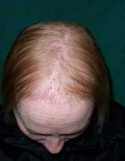 hair loss-anorexia-lanugo