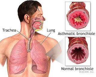 Bronchial Asthma Symptoms