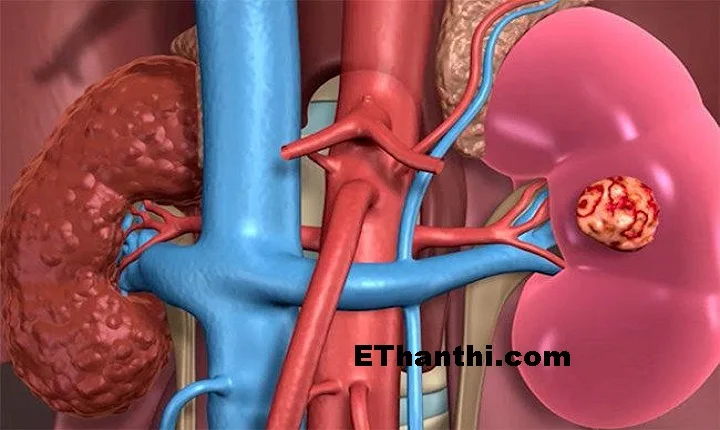 சிறுநீரக செயலிழப்பை கண்டறிவது எப்படி?