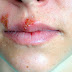 Obat Herpes Pada Bibir
