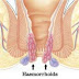 Wasir, Kenali dan Cari Tahu Cara Mengatasainya