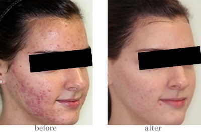 MENCARI KEBAHAGIAAN HIDUP: ROSACEA: Rawatan Semulajadi 