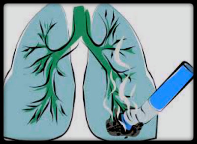 síntomas del cancer de pulmon