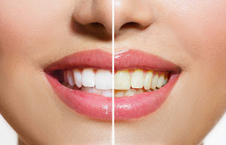 5 Tips for whitening teeth