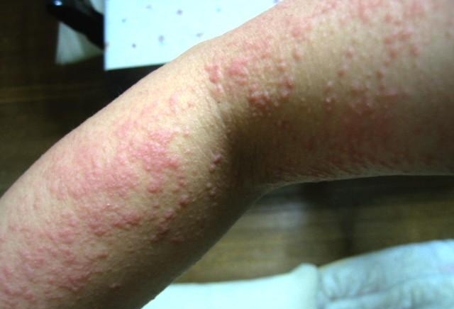 Bintik Yang Terasa Gatal Di Lengan Dan Kaki Karena Molluscum Contagiosum (Infeksi Virus) 